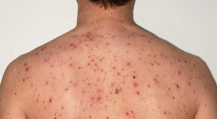Crianças entre seis meses e menores de um ano devem ser vacinadas contra o sarampo