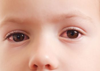 Adenovírus causa quadro de gripe e conjuntivite ao mesmo tempo em crianças