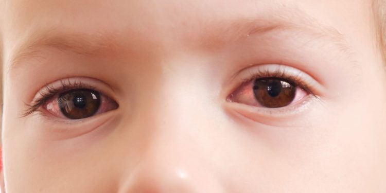 Adenovírus causa quadro de gripe e conjuntivite ao mesmo tempo em crianças