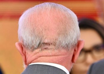 Presidente Lula fará nova cirurgia para impedir novo sangramento
