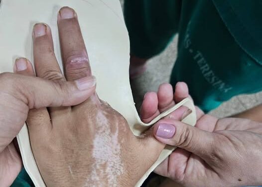HUT é o único hospital de urgência do Nordeste que produz e adapta órteses para pacientes internados